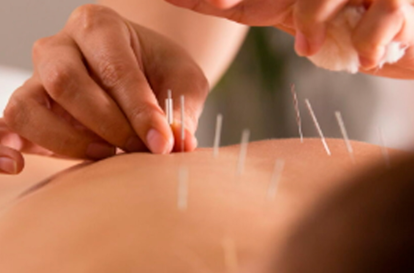 Cansado dos remédios? A acupuntura oferece uma alternativa natural e eficaz para tratar doenças mentais